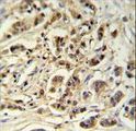 METT11D1 Antibody - M11D1 Antibody IHC of formalin-fixed and paraffin-embedded breast carcinoma followed by peroxidase-conjugated secondary antibody and DAB staining.