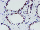 METTL16 / METT10D Antibody - IHC of paraffin-embedded Carcinoma of Human prostate tissue using anti-METT10D mouse monoclonal antibody. (Heat-induced epitope retrieval by 10mM citric buffer, pH6.0, 100C for 10min).