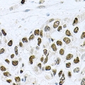 METTL3 Antibody - Immunohistochemical analysis of METTL3 staining in human lung cancer formalin fixed paraffin embedded tissue section. The section was pre-treated using heat mediated antigen retrieval with sodium citrate buffer (pH 6.0). The section was then incubated with the antibody at room temperature and detected using an HRP conjugated compact polymer system. DAB was used as the chromogen. The section was then counterstained with hematoxylin and mounted with DPX.