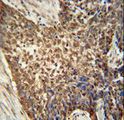 METTL4 Antibody - METTL4 antibody immunohistochemistry of formalin-fixed and paraffin-embedded human Lung carcinoma followed by peroxidase-conjugated secondary antibody and DAB staining.