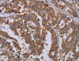 MFAP3L / NYD-Sp9 Antibody - Immunohistochemistry of paraffin-embedded Human liver cancer using MFAP3L Polyclonal Antibody at dilution of 1:50.