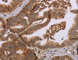 MFAP5 / MAGP2 Antibody - Immunohistochemistry of paraffin-embedded Human gastric cancer using MFAP5 Polyclonal Antibody at dilution of 1:40.