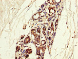 MGP / Matrix Gla-Protein Antibody - IHC image of MGP Antibody diluted at 1:300 and staining in paraffin-embedded human breast cancer performed on a Leica BondTM system. After dewaxing and hydration, antigen retrieval was mediated by high pressure in a citrate buffer (pH 6.0). Section was blocked with 10% normal goat serum 30min at RT. Then primary antibody (1% BSA) was incubated at 4°C overnight. The primary is detected by a biotinylated secondary antibody and visualized using an HRP conjugated SP system.