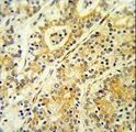 MGST2 Antibody - Formalin-fixed and paraffin-embedded human prostate carcinoma reacted with MGST2 Antibody ,which was peroxidase-conjugated to the secondary antibody, followed by DAB staining. This data demonstrates the use of this antibody for immunohistochemistry; clinical relevance has not been evaluated.