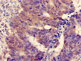 MGST2 Antibody - Immunohistochemistry of paraffin-embedded human colon cancer at dilution of 1:100