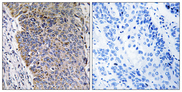 MGST3 Antibody - Immunohistochemistry analysis of paraffin-embedded human lung carcinoma tissue, using MGST3 Antibody. The picture on the right is blocked with the synthesized peptide.