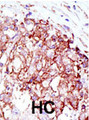 MIB1 Antibody - Formalin-fixed and paraffin-embedded human cancer tissue reacted with the primary antibody, which was peroxidase-conjugated to the secondary antibody, followed by AEC staining. This data demonstrates the use of this antibody for immunohistochemistry; clinical relevance has not been evaluated. BC = breast carcinoma; HC = hepatocarcinoma.
