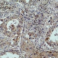 MICU1 / CBARA1 Antibody - Immunohistochemical analysis of MICU1 staining in human lung cancer formalin fixed paraffin embedded tissue section. The section was pre-treated using heat mediated antigen retrieval with sodium citrate buffer (pH 6.0). The section was then incubated with the antibody at room temperature and detected using an HRP conjugated compact polymer system. DAB was used as the chromogen. The section was then counterstained with hematoxylin and mounted with DPX.