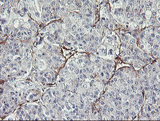 MIER2 Antibody - IHC of paraffin-embedded Carcinoma of Human liver tissue using anti-MIER2 mouse monoclonal antibody.