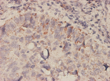 MIF Antibody - Immunoperoxidase of monoclonal antibody to MIF on formalin-fixed paraffin-embedded human lung, adenosquamous cell carcinoma tissue.