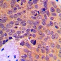MINPP1 Antibody - Immunohistochemical analysis of MINPP1 staining in human breast cancer formalin fixed paraffin embedded tissue section. The section was pre-treated using heat mediated antigen retrieval with sodium citrate buffer (pH 6.0). The section was then incubated with the antibody at room temperature and detected with HRP and DAB as chromogen. The section was then counterstained with hematoxylin and mounted with DPX.