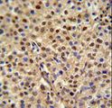 MISP / C19orf21 Antibody - C19orf21 Antibody IHC of formalin-fixed and paraffin-embedded human cervix carcinoma followed by peroxidase-conjugated secondary antibody and DAB staining.