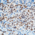 MITF Antibody - Immunohistochemical staining using microphthalmia antibody on formalin fixed, paraffin embedded human melanoma.