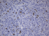 MKI67 / Ki67 Antibody - IHC of paraffin-embedded Adenocarcinoma of Human ovary tissue using anti-${SYMBOL} mouse monoclonal antibody.