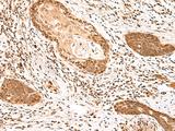 MKX Antibody - Immunohistochemistry of paraffin-embedded Human esophagus cancer tissue  using MKX Polyclonal Antibody at dilution of 1:60(×200)