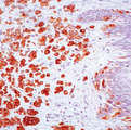 MLANA / Melan-A Antibody - Formalin-fixed, paraffin-embedded human compound nevus stained with peroxidase-conjugate and DAB chromogen. Note cytoplasmic staining of melanocytes.  This image was taken for the unmodified form of this product. Other forms have not been tested.