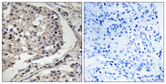 MLK1+2 Antibody - Immunohistochemistry analysis of paraffin-embedded human breast carcinoma tissue, using MLK1/2 Antibody. The picture on the right is blocked with the synthesized peptide.