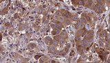 MLKL Antibody - 1:100 staining human liver carcinoma tissues by IHC-P. The sample was formaldehyde fixed and a heat mediated antigen retrieval step in citrate buffer was performed. The sample was then blocked and incubated with the antibody for 1.5 hours at 22°C. An HRP conjugated goat anti-rabbit antibody was used as the secondary.