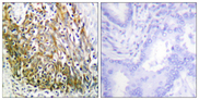 MMP10 Antibody - Immunohistochemistry analysis of paraffin-embedded human lung carcinoma tissue, using MMP-10 Antibody. The picture on the right is blocked with the synthesized peptide.