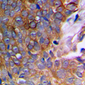 MMP10 Antibody - Immunohistochemical analysis of MMP10 staining in human prostate cancer formalin fixed paraffin embedded tissue section. The section was pre-treated using heat mediated antigen retrieval with sodium citrate buffer (pH 6.0). The section was then incubated with the antibody at room temperature and detected using an HRP conjugated compact polymer system. DAB was used as the chromogen. The section was then counterstained with hematoxylin and mounted with DPX.