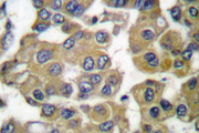 MMP11 Antibody - IHC of MMP-11 (G88) pAb in paraffin-embedded human breast carcinoma tissue.