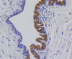 MMP12 Antibody - Immunohistochemistry of paraffin-embedded human mammary cancer using MMP12 antibodyat dilution of 1:100 (40x lens).