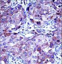 MMP13 Antibody - MMP13 Antibody immunohistochemistry of formalin-fixed and paraffin-embedded human breast carcinoma followed by peroxidase-conjugated secondary antibody and DAB staining.