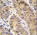 MMP13 Antibody - Formalin-fixed and paraffin-embedded human hepatocarcinoma tissue reacted with MMP13 antibody , which was peroxidase-conjugated to the secondary antibody, followed by DAB staining. This data demonstrates the use of this antibody for immunohistochemistry; clinical relevance has not been evaluated.