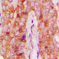 MMP13 Antibody - Immunohistochemical analysis of MMP13 staining in human breast cancer formalin fixed paraffin embedded tissue section. The section was pre-treated using heat mediated antigen retrieval with sodium citrate buffer (pH 6.0). The section was then incubated with the antibody at room temperature and detected using an HRP conjugated compact polymer system. DAB was used as the chromogen. The section was then counterstained with hematoxylin and mounted with DPX.