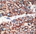 MMP14 Antibody - Formalin-fixed and paraffin-embedded human cancer tissue reacted with the primary antibody, which was peroxidase-conjugated to the secondary antibody, followed by DAB staining. This data demonstrates the use of this antibody for immunohistochemistry; clinical relevance has not been evaluated. BC = breast carcinoma; HC = hepatocarcinoma.