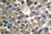MMP19 Antibody - IHC of MMP-19 (G44) pAb in paraffin-embedded human breast carcinoma tissue.
