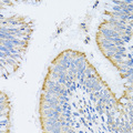 MMP19 Antibody - Immunohistochemistry of paraffin-embedded human lung cancer tissue.