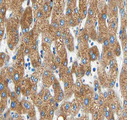 MMP19 Antibody - 1:100 staining human liver carcinoma tissues by IHC-P. The tissue was formaldehyde fixed and a heat mediated antigen retrieval step in citrate buffer was performed. The tissue was then blocked and incubated with the antibody for 1.5 hours at 22 °C. An HRP conjugated goat anti-rabbit antibody was used as the secondary.