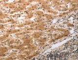 MMP27 Antibody - Immunohistochemistry of paraffin-embedded Human liver cancer using MMP27 Polyclonal Antibody at dilution of 1:40.