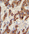 MMP3 Antibody - Formalin-fixed and paraffin-embedded human hepatocarcinoma reacted with MMP3 Antibody , which was peroxidase-conjugated to the secondary antibody, followed by DAB staining. This data demonstrates the use of this antibody for immunohistochemistry; clinical relevance has not been evaluated.