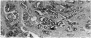 MMP3 Antibody - Left: IHC of human gastric carcinoma tissue using MMP-3 antibody (Matrix Metalloproteinase 3 (MMP3)). Right: Western blot of recombinant human MMP-3 proenzyme using MMP-3 antibody.