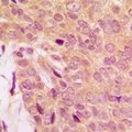 MNK / ATP7A Antibody - Immunohistochemical analysis of ATP7A staining in human breast cancer formalin fixed paraffin embedded tissue section. The section was pre-treated using heat mediated antigen retrieval with sodium citrate buffer (pH 6.0). The section was then incubated with the antibody at room temperature and detected using an HRP polymer system. DAB was used as the chromogen. The section was then counterstained with hematoxylin and mounted with DPX.