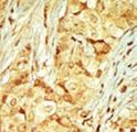 MOK / RAGE Antibody - Formalin-fixed and paraffin-embedded human cancer tissue reacted with the primary antibody, which was peroxidase-conjugated to the secondary antibody, followed by DAB staining. This data demonstrates the use of this antibody for immunohistochemistry; clinical relevance has not been evaluated. BC = breast carcinoma; HC = hepatocarcinoma.