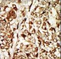 MOS Antibody - Formalin-fixed and paraffin-embedded human cancer tissue reacted with the primary antibody, which was peroxidase-conjugated to the secondary antibody, followed by AEC staining. This data demonstrates the use of this antibody for immunohistochemistry; clinical relevance has not been evaluated. BC = breast carcinoma; HC = hepatocarcinoma.