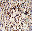 MOSC2 Antibody - Formalin-fixed and paraffin-embedded human lung carcinoma reacted with MOSC2 Antibody , which was peroxidase-conjugated to the secondary antibody, followed by DAB staining. This data demonstrates the use of this antibody for immunohistochemistry; clinical relevance has not been evaluated.