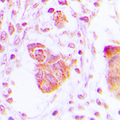 MOV10L1 Antibody - Immunohistochemical analysis of MOV10L1 staining in human lung cancer formalin fixed paraffin embedded tissue section. The section was pre-treated using heat mediated antigen retrieval with sodium citrate buffer (pH 6.0). The section was then incubated with the antibody at room temperature and detected using an HRP conjugated compact polymer system. DAB was used as the chromogen. The section was then counterstained with hematoxylin and mounted with DPX.