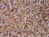 MOV10L1 Antibody - Immunohistochemistry Dilution at 1:400 and staining in paraffin-embedded human liver cancer performed on a Leica BondTM system. After dewaxing and hydration, antigen retrieval was mediated by high pressure in a citrate buffer (pH 6.0). Section was blocked with 10% normal Goat serum 30min at RT. Then primary antibody (1% BSA) was incubated at 4°C overnight. The primary is detected by a biotinylated Secondary antibody and visualized using an HRP conjugated SP system.