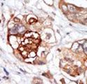 MPS1 / TTK Antibody - Formalin-fixed and paraffin-embedded human cancer tissue reacted with the primary antibody, which was peroxidase-conjugated to the secondary antibody, followed by DAB staining. This data demonstrates the use of this antibody for immunohistochemistry; clinical relevance has not been evaluated. BC = breast carcinoma; HC = hepatocarcinoma.