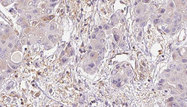 MRGD / MRGPRD Antibody - 1:100 staining human liver carcinoma tissues by IHC-P. The sample was formaldehyde fixed and a heat mediated antigen retrieval step in citrate buffer was performed. The sample was then blocked and incubated with the antibody for 1.5 hours at 22°C. An HRP conjugated goat anti-rabbit antibody was used as the secondary.