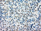 MRI1 Antibody - IHC of paraffin-embedded Adenocarcinoma of ovary tissue using anti-MRI1 mouse monoclonal antibody. (Dilution 1:50).