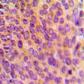 MRPL10 Antibody - Immunohistochemical analysis of MRPL10 staining in human breast cancer formalin fixed paraffin embedded tissue section. The section was pre-treated using heat mediated antigen retrieval with sodium citrate buffer (pH 6.0). The section was then incubated with the antibody at room temperature and detected using an HRP conjugated compact polymer system. DAB was used as the chromogen. The section was then counterstained with hematoxylin and mounted with DPX.