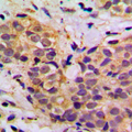 MRPL11 Antibody - Immunohistochemical analysis of MRPL11 staining in human breast cancer formalin fixed paraffin embedded tissue section. The section was pre-treated using heat mediated antigen retrieval with sodium citrate buffer (pH 6.0). The section was then incubated with the antibody at room temperature and detected using an HRP conjugated compact polymer system. DAB was used as the chromogen. The section was then counterstained with hematoxylin and mounted with DPX.