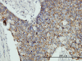 MRPL12 Antibody - Immunoperoxidase of monoclonal antibody to MRPL12 on formalin-fixed paraffin-embedded human breast cancer tissue. [antibody concentration 3 ug/ml].