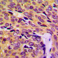 MRPL14 Antibody - Immunohistochemical analysis of MRPL14 staining in human breast cancer formalin fixed paraffin embedded tissue section. The section was pre-treated using heat mediated antigen retrieval with sodium citrate buffer (pH 6.0). The section was then incubated with the antibody at room temperature and detected using an HRP conjugated compact polymer system. DAB was used as the chromogen. The section was then counterstained with hematoxylin and mounted with DPX.