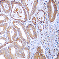 MRPL24 Antibody - Immunohistochemical analysis of MRPL24 staining in human colon cancer formalin fixed paraffin embedded tissue section. The section was pre-treated using heat mediated antigen retrieval with sodium citrate buffer (pH 6.0). The section was then incubated with the antibody at room temperature and detected using an HRP conjugated compact polymer system. DAB was used as the chromogen. The section was then counterstained with hematoxylin and mounted with DPX.